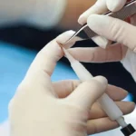 saç ekimi sonrası 10. gün