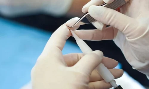 saç ekimi sonrası 10. gün